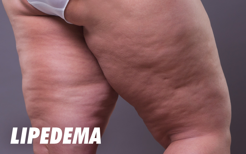 En este momento estás viendo QUÉ ES EL LIPEDEMA Y CÓMO TRATAR ESTA ENFERMEDAD DESDE LA NUTRICIÓN Y EL ENTRENAMIENTO